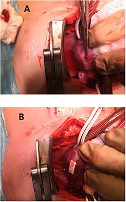 Hybrid Procedures. Opening Doors for Surgeon and Cardiologist Close Collaboration